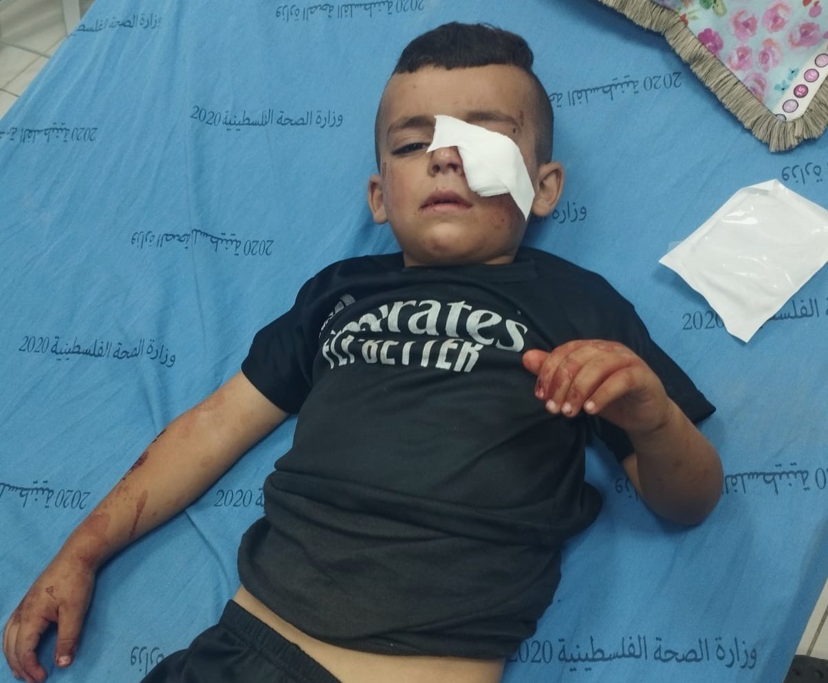 Child suffers burns from attack by settlers in Masafer Yatta