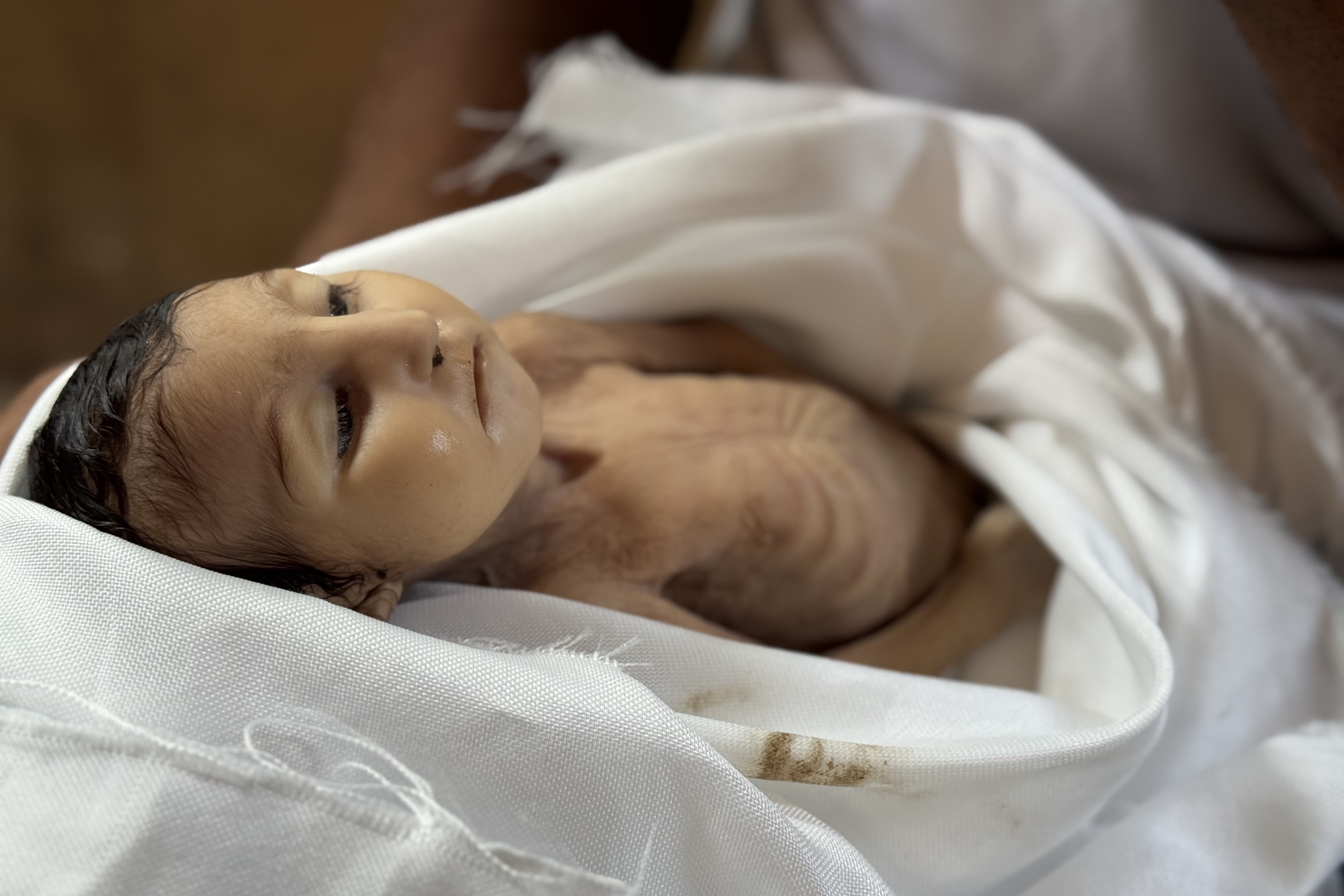 Five-month-old infant Ghadeer Brika, victim of malnutrition in Khan Yunis (Anadolu)