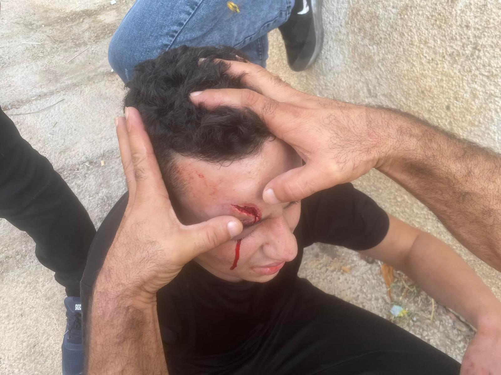 A 15-year-old Palestinian boy loses an eye after hit by an Israeli army rubber bullet in Kafr Qaddum