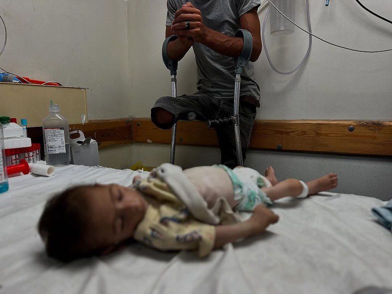 4-year-old girl dies of malnutrition in Gaza amid ongoing famine due to Israeli blockade